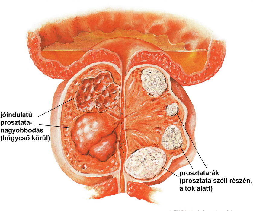 prostatitis és sérülés