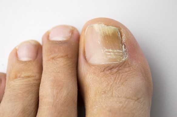 nail fungus cipő kezelés