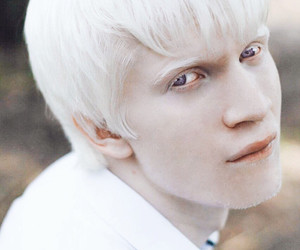 Albinizmus