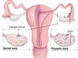 Pcos