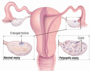 Pcos