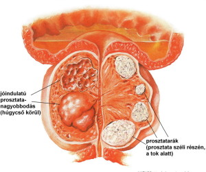 Prosztata