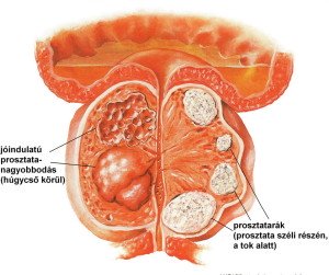 Prosztata